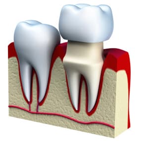 What Is a Dental Crown? Types, the Procedure, and Same-Day CEREC Crowns